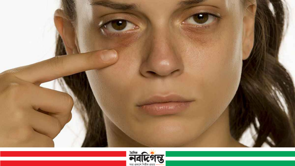 চোখের নিচে কালো দাগ: শুধু ক্লান্তি নয়, হতে পারে নানা সমস্যার সংকেত
