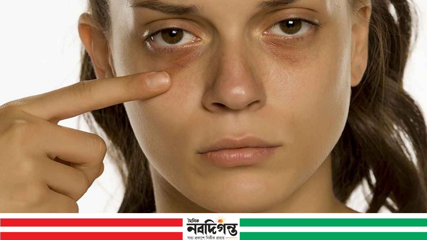 চোখের নিচে কালো দাগ: শুধু ক্লান্তি নয়, হতে পারে নানা সমস্যার সংকেত
