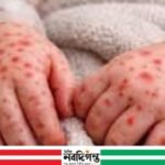 রূপগঞ্জে হামে আরও এক শিশুর মৃত্যু, বেড়েছে উদ্বেগ