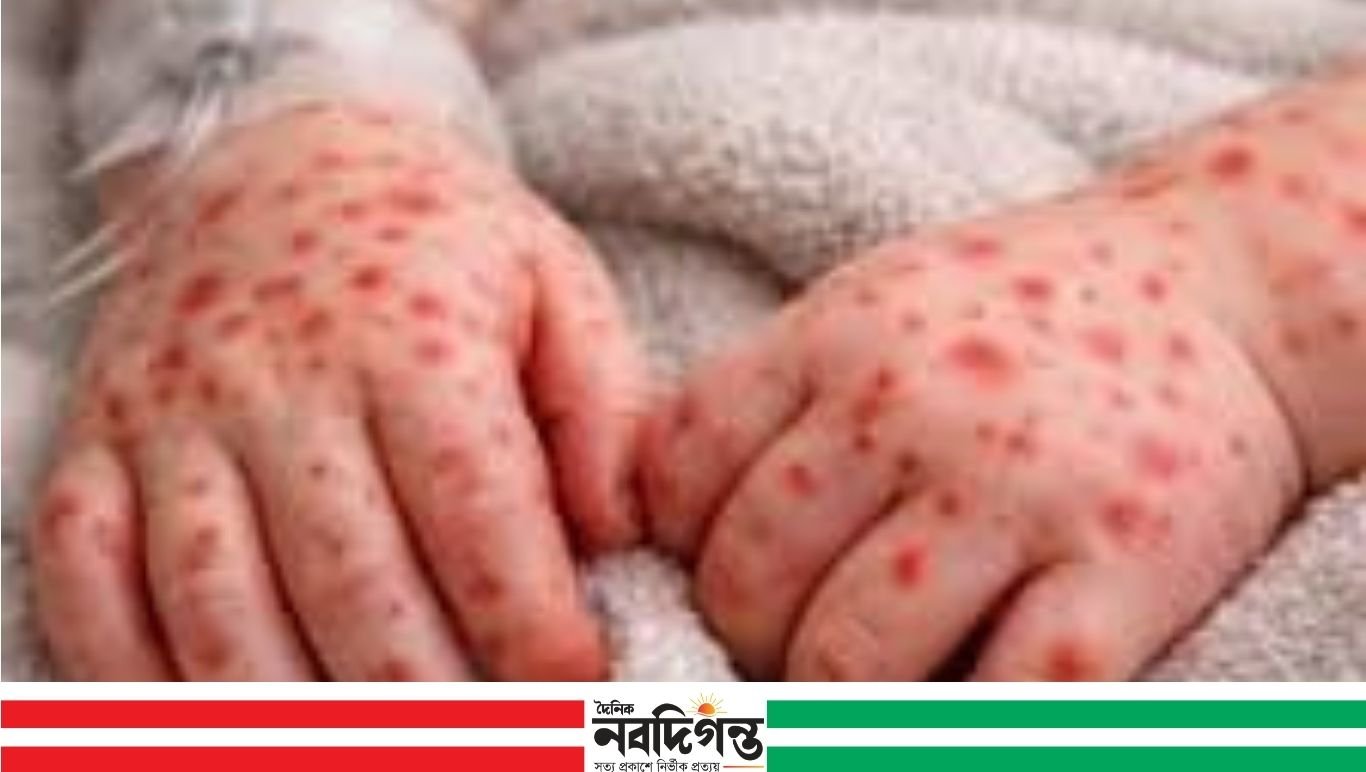 রূপগঞ্জে হামে আরও এক শিশুর মৃত্যু, বেড়েছে উদ্বেগ
